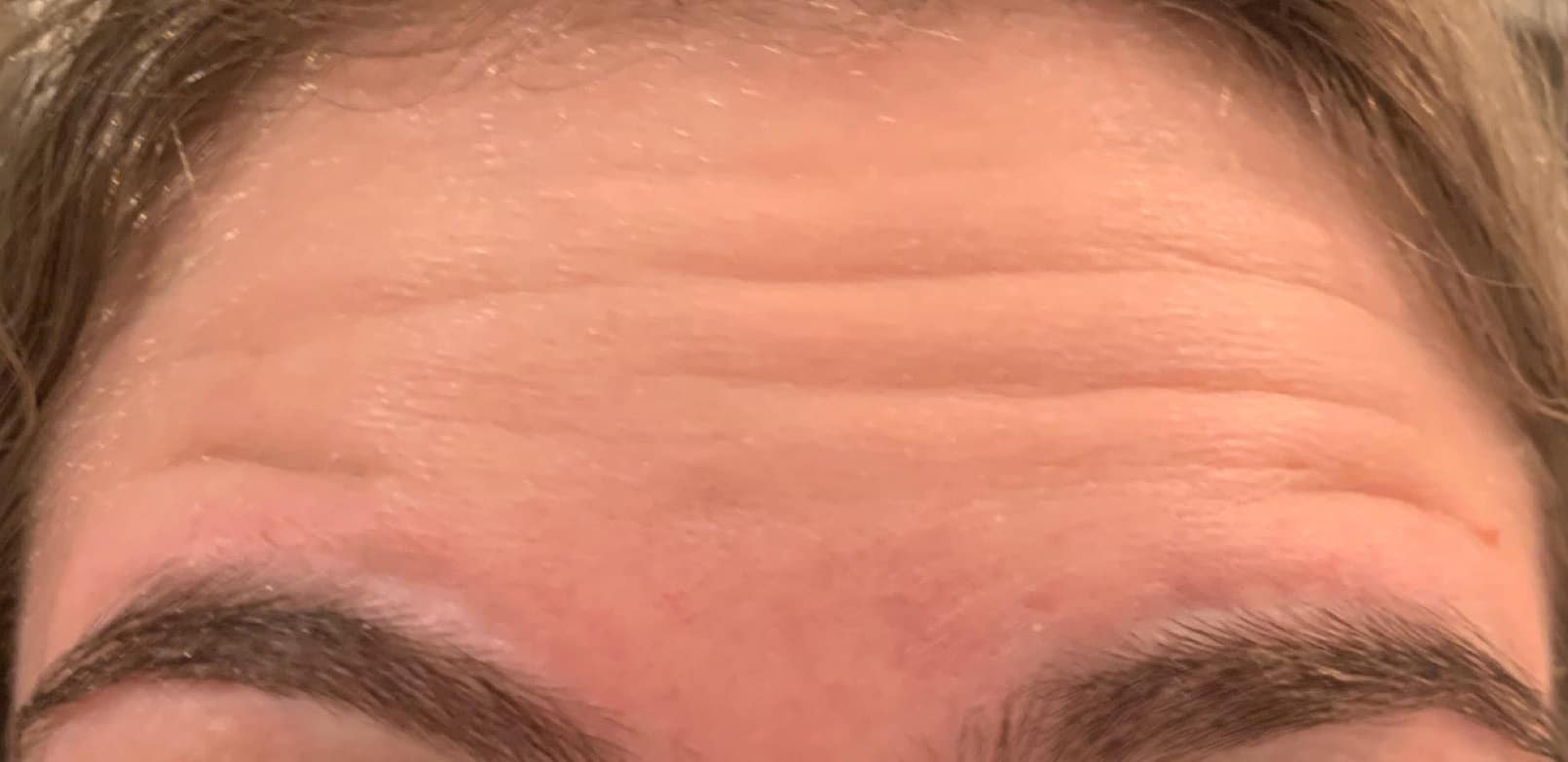 Neurotoxin Treatment 2 - Seattle Beauty