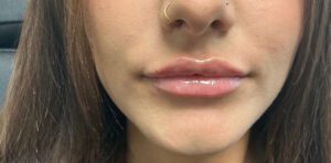 After Image: Lip Filler