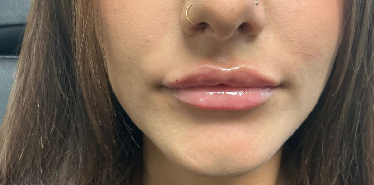 After Image: Lip Filler - front