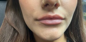 Before Image: Lip Filler