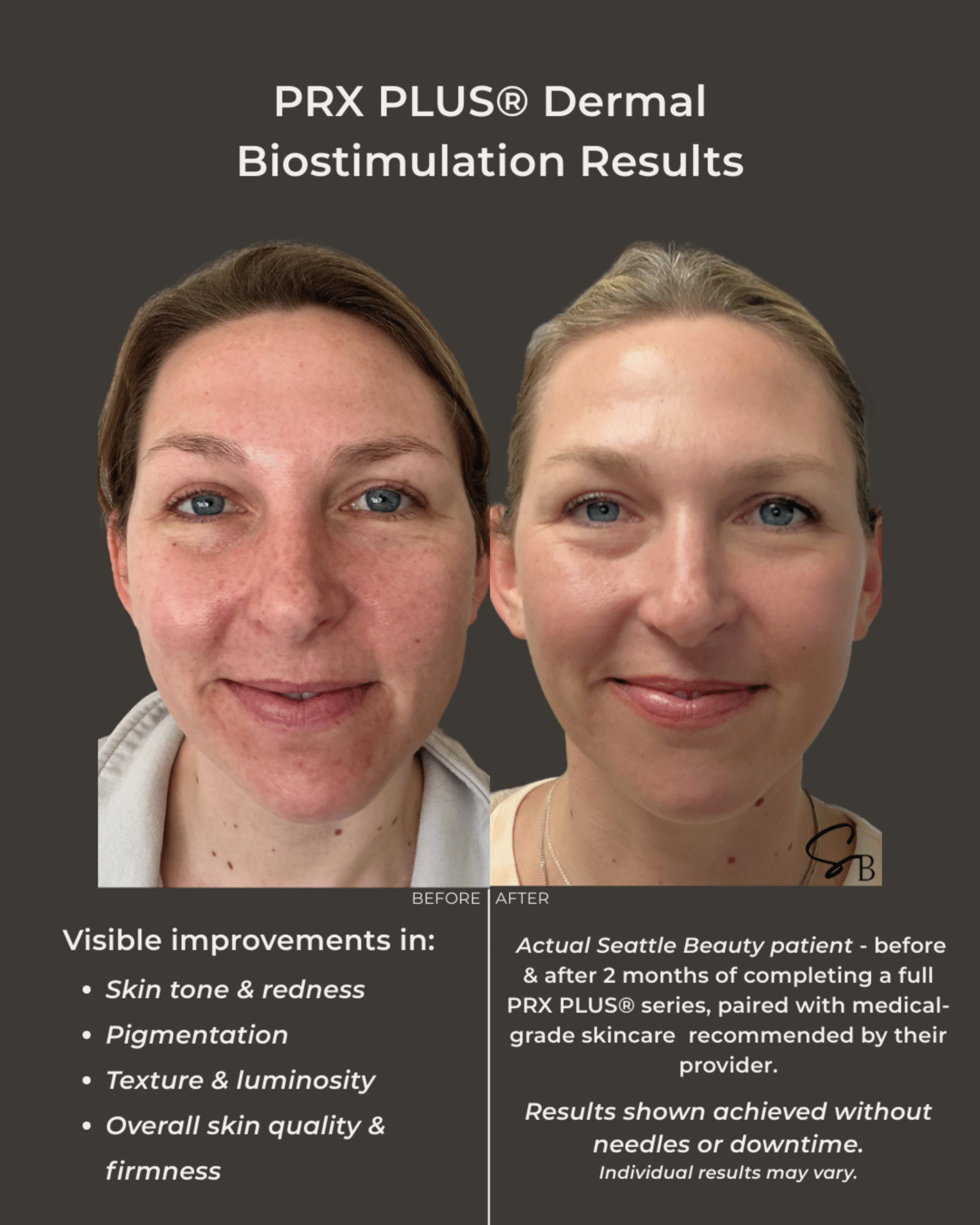 prx plus before after seattle beauty