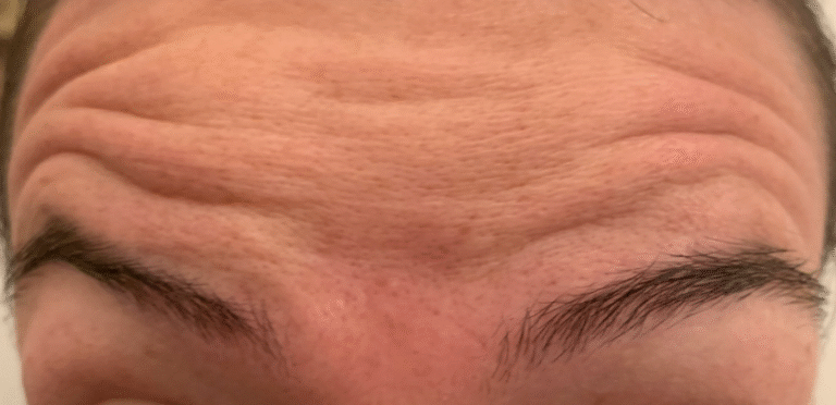 Before Image: Botox - other