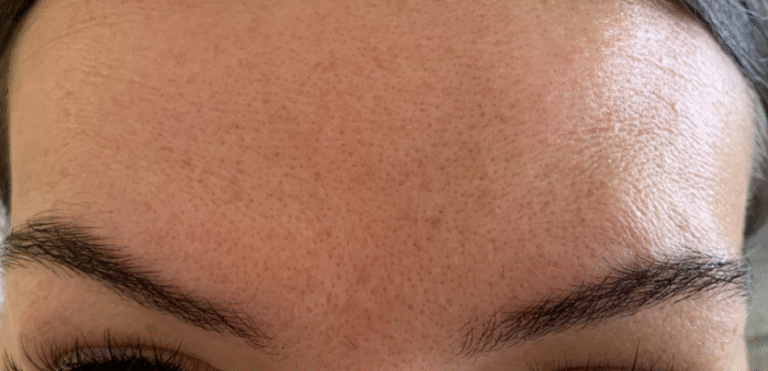 After Image: Botox - other