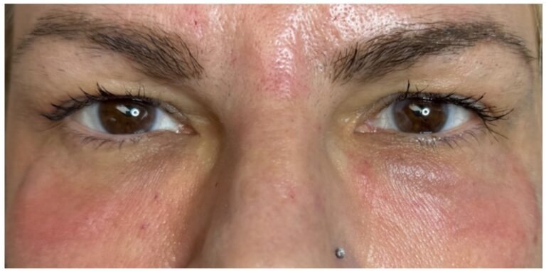 After Image: PRX Intima Eye - front