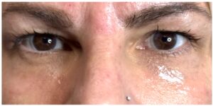 Before Image: PRX Intima Eye