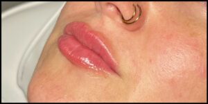 After Image: Lip Filler