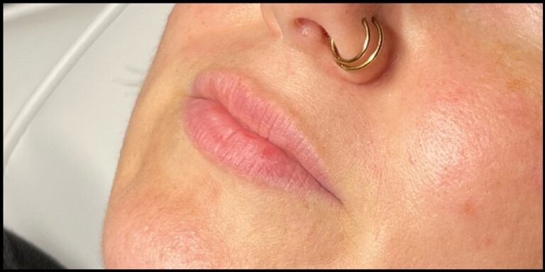 Before Image: Lip Filler - front