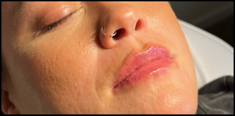 After Image: Lip Filler - front