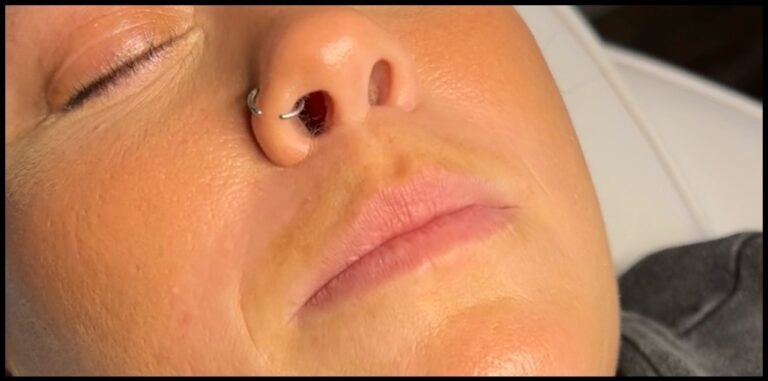 Before Image: Lip Filler - front