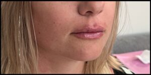 After Image: Lip Filler