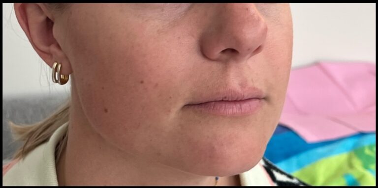 Before Image: Lip Filler - front