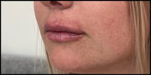 After Image: Lip Filler