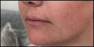 Before Image: Lip Filler