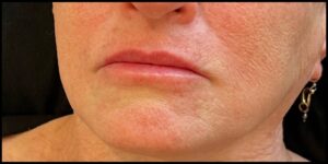 After Image: Lip Filler