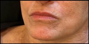 Before Image: Lip Filler