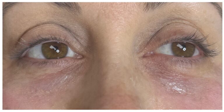 After Image: Undereye PRP (Platelet Rich Plasma) - front