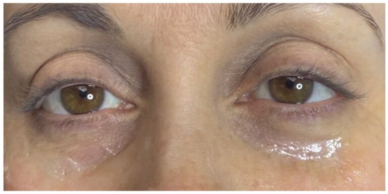 Before Image: Undereye PRP (Platelet Rich Plasma) - front