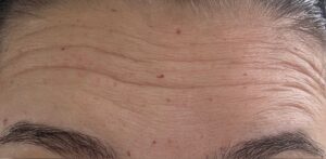 Before Image: Wrinkle Relaxer