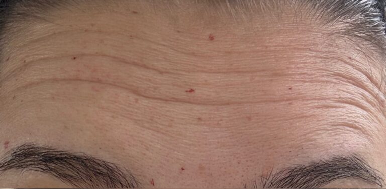 Before Image: Wrinkle Relaxer - front