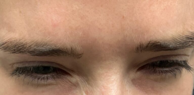 After Image: Botox - front