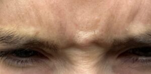 Before Image: Botox