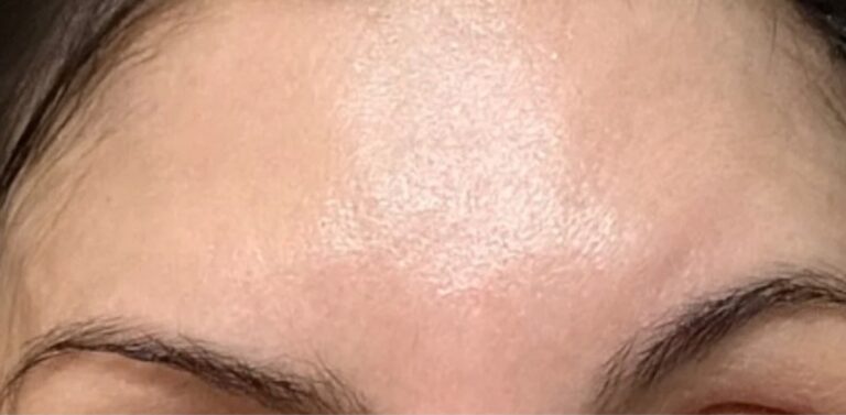 After Image: Botox - front