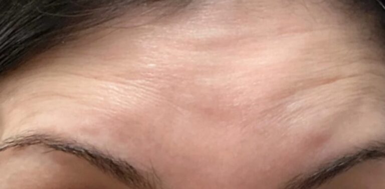 Before Image: Botox - front