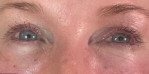 After Image: Undereye PRP (Platelet Rich Plasma) + Botox