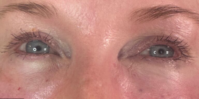 After Image: Undereye PRP (Platelet Rich Plasma) + Botox - front