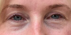 Before Image: Undereye PRP (Platelet Rich Plasma) + Botox