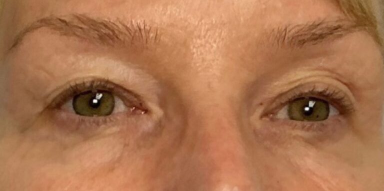 After Image: Undereye PRP (Platelet Rich Plasma) - front