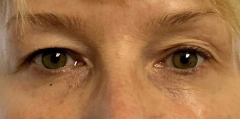 Before Image: Undereye PRP (Platelet Rich Plasma) - front
