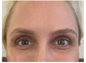 After Image: Undereye PRP (Platelet Rich Plasma)