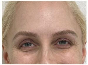 Before Image: Undereye PRP (Platelet Rich Plasma)