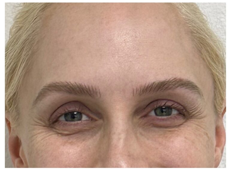 Before Image: Undereye PRP (Platelet Rich Plasma) - front