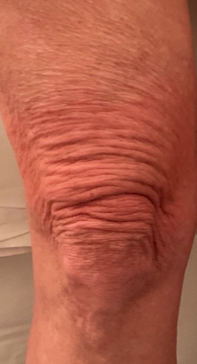 Before Image: Morpheus 8 - front