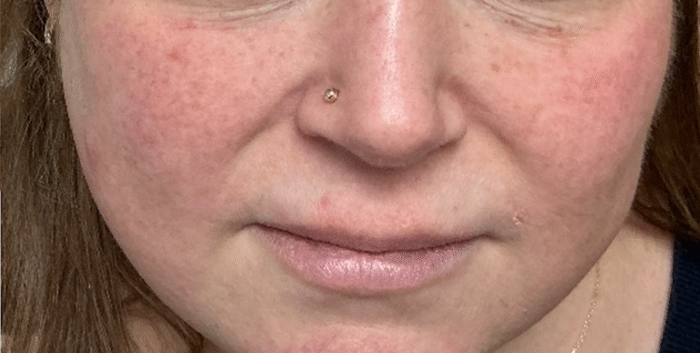 After Image: IPL Face – Cheeks - front
