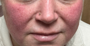 Before Image: IPL Face – Cheeks