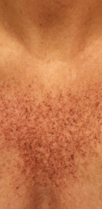 Before Image: IPL Chest / Decelotte