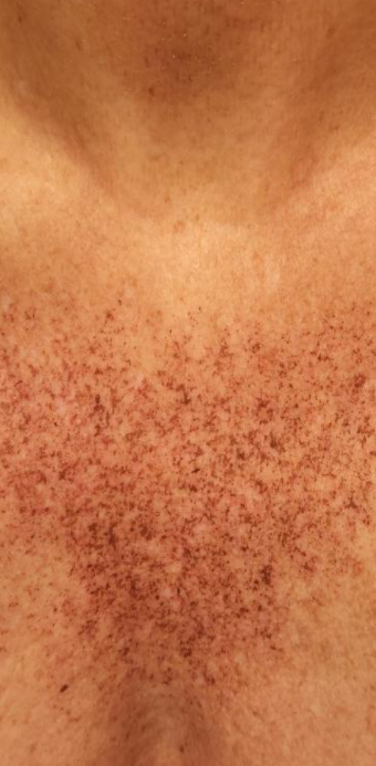 Before Image: IPL Chest / Decelotte - front