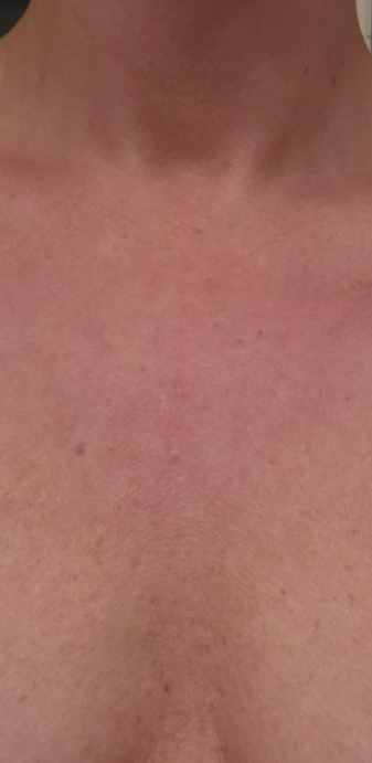 After Image: IPL Chest / Decelotte - front